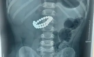 31 магнит в животе: как хирурги спасли малыша?