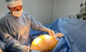 В Алматы успешно удалена 25-килограммовая опухоль у пациентки с дедифференцированной липосаркомой