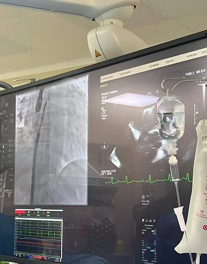 В НИИ КАРДИОЛОГИИ И ВНУТРЕННИХ БОЛЕЗНЕЙ ПРОВЕДЕНЫ УНИКАЛЬНЫЕ ОПЕРАЦИИ ПО ТЕХНОЛОГИИ TEER (2)